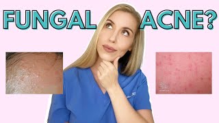 Do YOU have Fungal Acne  Dermatologist Talks Symptoms and Treatments [upl. by Ymij]