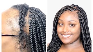 LACE FRONTAL BOX BRAIDS FOR THINNING HAIR  NO WIG NEEDED [upl. by Weisbrodt]