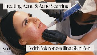 This Is Microneedling for Acne Scarring 🎯 [upl. by Danette]