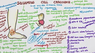 Squamous Cell Carcinoma  Pathology [upl. by Trista610]