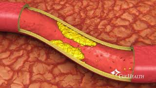 Heart Stents [upl. by Radloff]