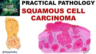 SQUAMOUS CELL CARCINOMA Clinical features amp Morphology Premalignant lesions [upl. by Eiramanin]