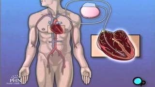 Permanent Pacemaker Implant Surgery [upl. by Aititil]