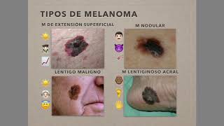 Melanoma [upl. by Notsirt]