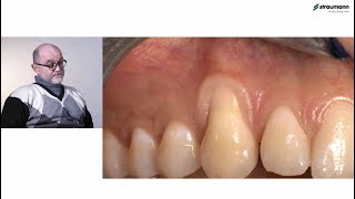 Prof Giovanni Zucchelli Treatment of class I gingival recession [upl. by Gosser255]