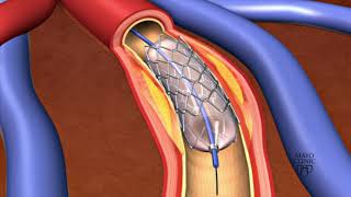 External Iliac Artery Stenting [upl. by Huan]