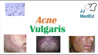 Acne Vulgaris  Causes Pathogenesis Influencing Factors Diagnosis Treatment and Complications [upl. by Etnoval267]