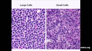 Signs and symptoms of lymphoma  Mayo Clinic [upl. by Renferd]