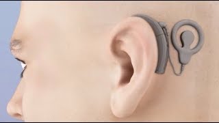 Cochlear Implant Animation [upl. by Lleryt]