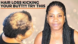 HOW TO BOX BRAID FOR BEGINNERS ALOPECIA VERSION [upl. by Bortz948]