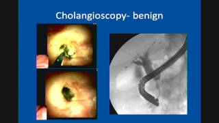 Primary Sclerosing Cholangitis Update in Management [upl. by Sair]