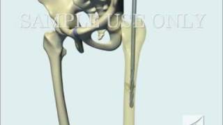 Femoral Fracture Fixation Surgery Intramedullary Nail [upl. by Ytsanyd601]