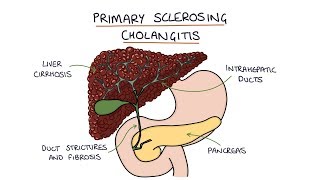 Cholecystitis Nursing NCLEX Pathophysiology Symptoms TTube amp Cholecystostomy [upl. by Carnahan73]