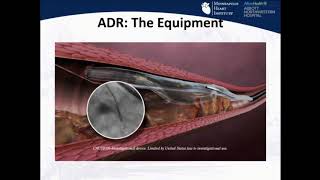 Antegrade DissectionReentry StepbyStep  M Nicholas Burke MD [upl. by Kylie950]