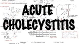 Acute Cholecystitis  Overview signs and symptoms pathophysiology treatment [upl. by Shaddock874]