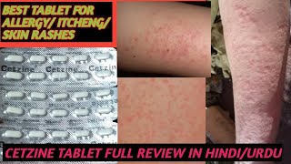 BEST TABLET FOR ALLERGY AND SKIN RASHES AND ITCHINGCETZINE TABLET FULL REVIEW IN HINDIURDU [upl. by Aelgna]