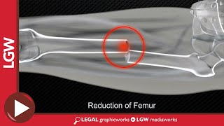 Midshaft Femur Fracture Intramedullary Nailing 3D Animation [upl. by Iloj]