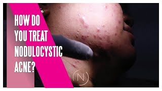 How Do You Treat Nodulocystic Acne  Houston Dermatology [upl. by Haissi412]