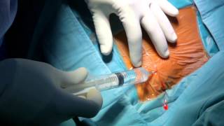 Pacemaker Implantation [upl. by Kcirtapnhoj]