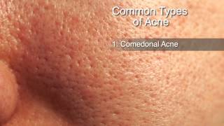 How to Treat Different Types of Acne [upl. by Layod]