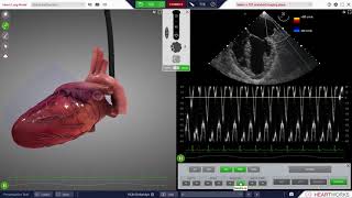 Hypokinesis Mitral Regurgitation Aortic Insufficiency [upl. by Autumn]