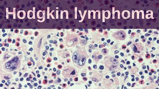 Hodgkin Lymphoma  Pathology mini tutorial [upl. by Astera]