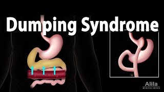 Dumping Syndrome Animation [upl. by Eilyw963]