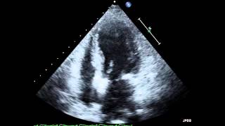 Takotsubo Cardiomyopathy Echocardiogram [upl. by Mayeda]