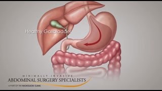 Gallbladder Symptoms [upl. by Efren]