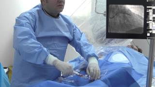 ARES  Angioplastie coronariana cu stent bioresorbabil Absorb  Dr Roberto Haret [upl. by Keavy306]