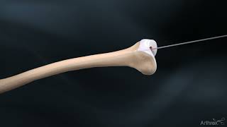 Femoral Nail System Overview [upl. by Sinne]