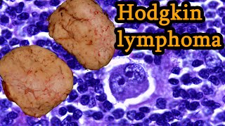 Hodgkins Lymphoma Symptoms Medical Oncologist Explains [upl. by Trace]