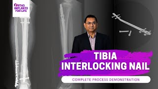 Tibia Interlocking Nail Complete Procedure [upl. by Lachish]