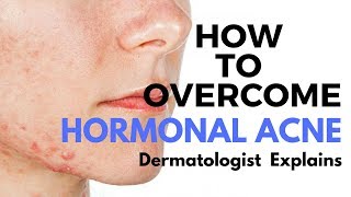 Skin Care Tips Treating HORMONAL ACNE [upl. by Radcliffe115]