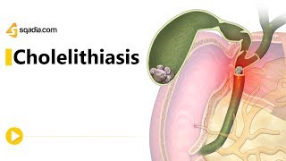 CHOLELITHIASIS GALL STONESPart 2 Pathogenesis Morphology Clinical FeaturesComplications [upl. by Hoi647]