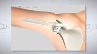 Dealing with Chronic Shoulder Pain [upl. by Tonnie747]